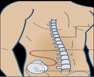 Spinal Cord Stimulation